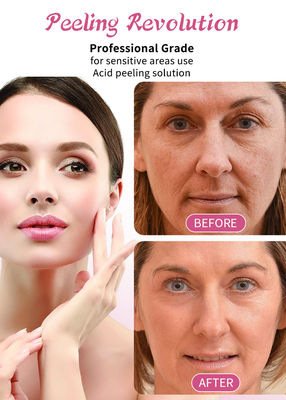 30 ml huid peeling serum / professionele kwaliteit vloeistof set voor gezichtshuid exfoliatie oplossing