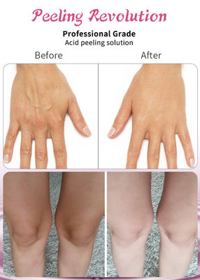 Acid Peeling Solution Liquid Set voor gezichtspeeling