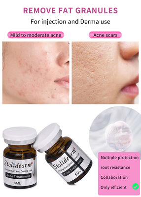 Stalidearm Dermale vulstoffen Acnebehandeling Injectie serum voor acne genezing en vlekvermindering