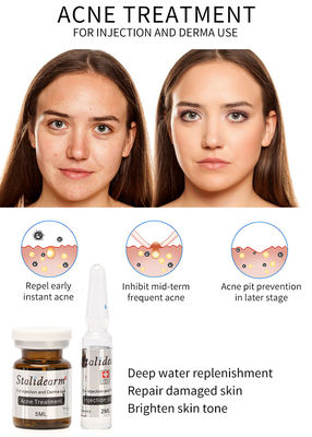 Van de de Behandelingsinjectie van de Stalidearmacne het Serum Mesotherapy die Geen Bijwerkingen voeden