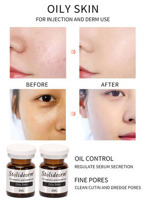 Injectieserum voor het Olieachtige Huid5ml/bottle Veilige Goede Effect Merk van Essentie Vastgestelde Originele Stalidearm